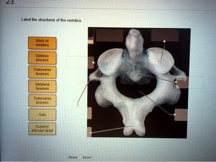 Solved Label The Structures Of The Vertebra Body Of Vertebra Spinous