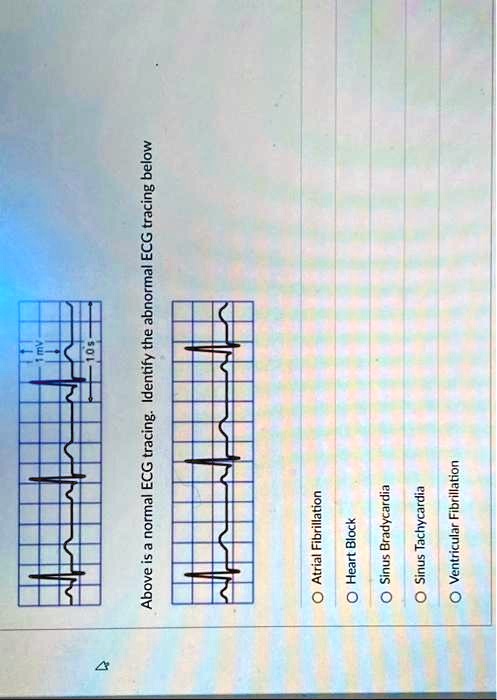 Solved Text Above Is A Normal Ecg Tracing Identify The Abnormal Ecg