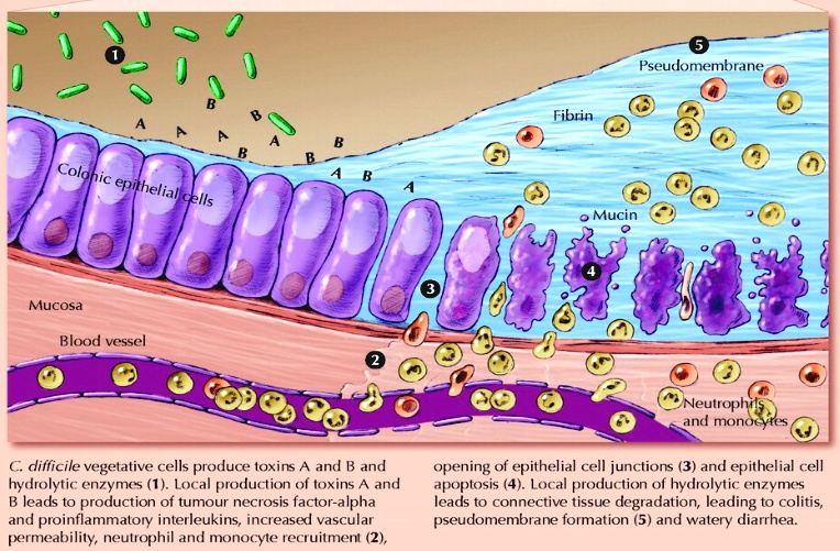 Solved Pseudomembrane Fibrin Colonic Epithelial Cells Mucin Mucosa