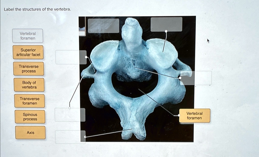 SOLVED Label The Structures Of The Vertebra Transverse Process