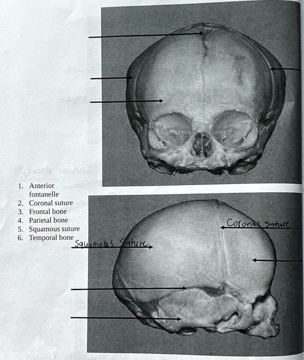 SOLVED: 1. Anterior fontanelle 2. Coronal suture 3. Frontal bone 4 ... Biology Diagrams