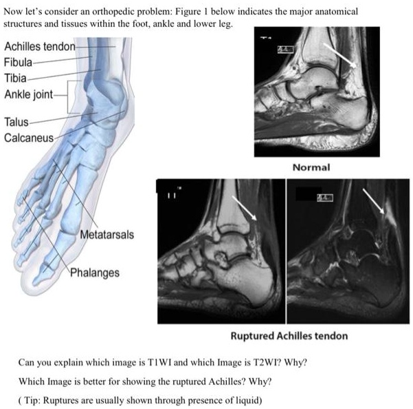 SOLVED: Now let's consider an orthopedic problem: The figure below ...