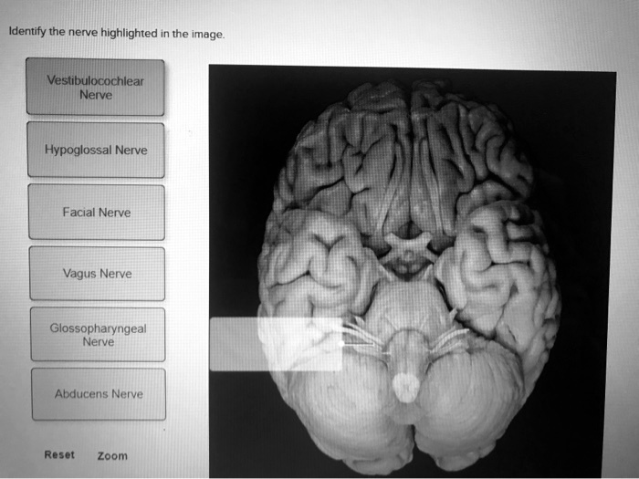 SOLVED: Identify the nerve highlighted in the image Vestibulocochlear ...