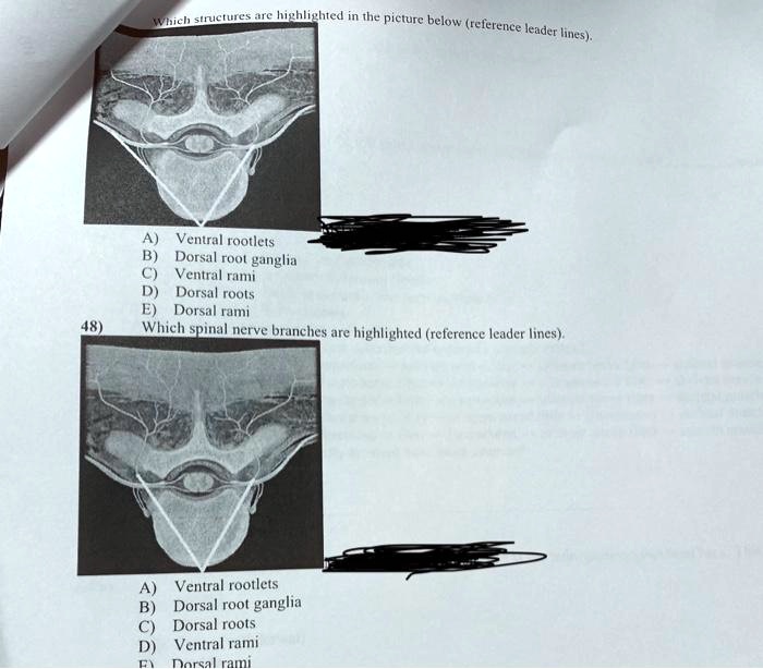 A) Ventral rootlets B) Dorsal root ganglia C) Ventral rami D) Dorsal ...