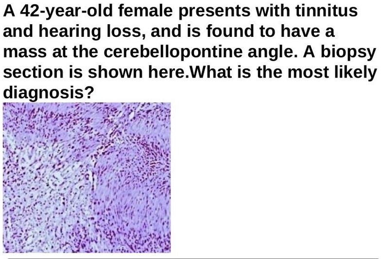 SOLVED: A 42-year-old female presents with tinnitus and hearing loss ...