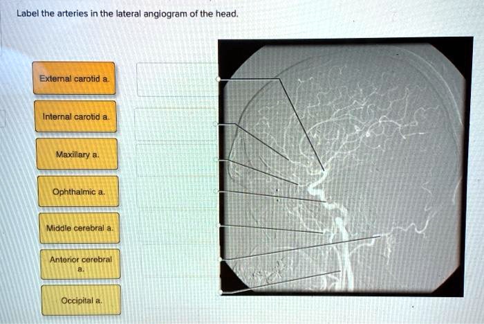 SOLVED: Label the arteries in the lateral angiogram of the head ...
