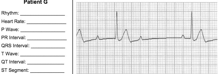 Patient G
Rhythm:
Heart Rate:
P Wave:
PR Interval:
QRS Interval:
T Wave:
QT Interval:
ST Segment: