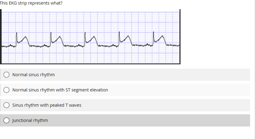 SOLVED: This EKG strip represents what? Normal sinus rhythm Normal ...