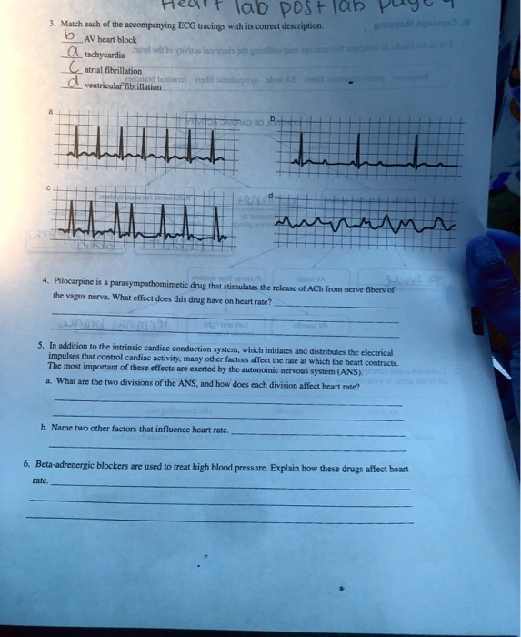 3. Match each of the accompanying ECG tracings with its correct description.
b AV heart block
a tachycardia
c atrial fibrillation
d ventricular fibrillation

a
b
c
d

4. Pilocarpine is a parasympathomimetic drug that stimulates the release of ACh from nerve fibers of the vagus nerve. What effect does this drug have on heart rate?
5. In addition to the intrinsic cardiac conduction system, which initiates and distributes the electrical impulses that control cardiac activity, many other factors affect the rate at which the heart contracts. The most important of these effects are exerted by the autonomic nervous system (ANS).
a. What are the two divisions of the ANS, and how does each division affect heart rate?
b. Name two other factors that influence heart rate.
6. Beta-adrenergic blockers are used to treat high blood pressure. Explain how these drugs affect heart rate.