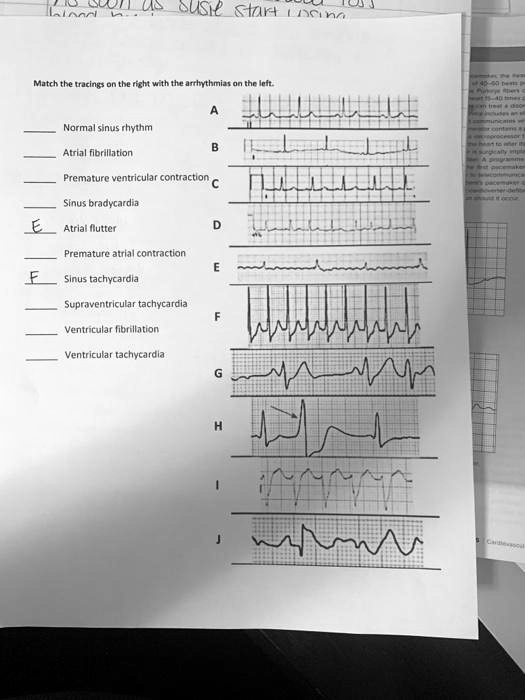 Match The Tracings On The Right With The Arrhythmias On The Left Normal ...