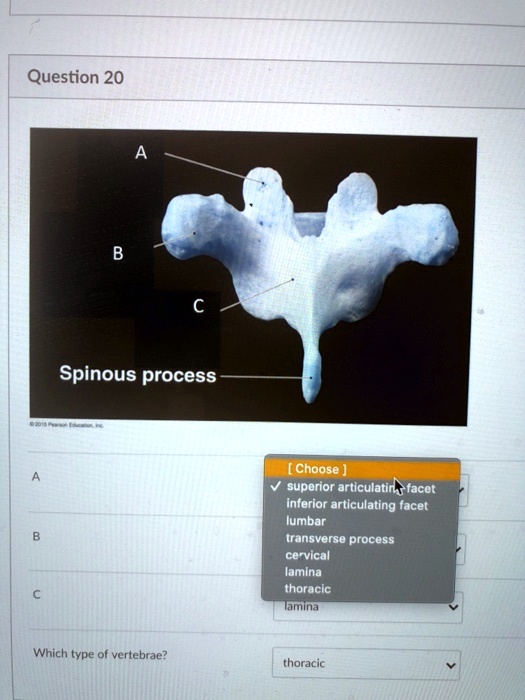 SOLVED Question 20 Spinous process [Choose] superior articulating