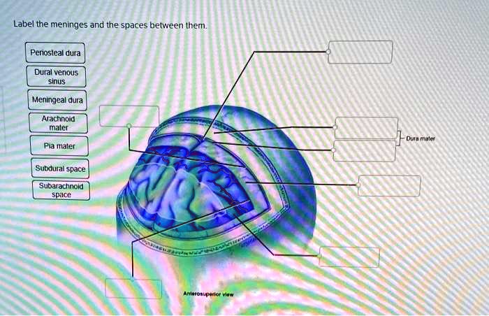 SOLVED: Label the meninges and the spaces between them Periosteal dura ...