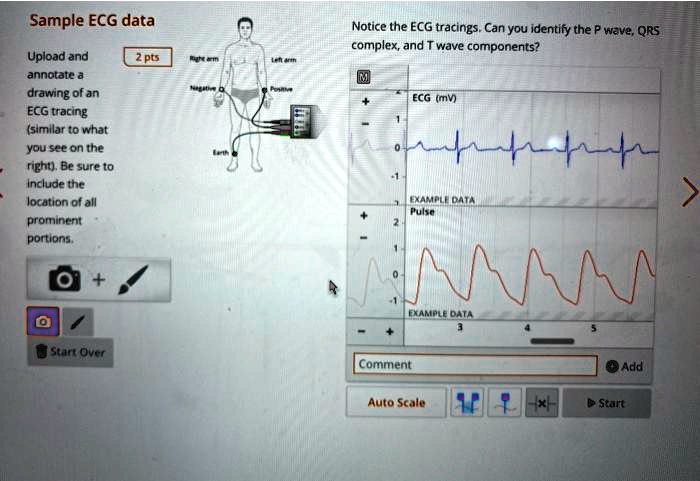 Notice the ECG tracings. Can you identify the P wave, QRS complex, and ...
