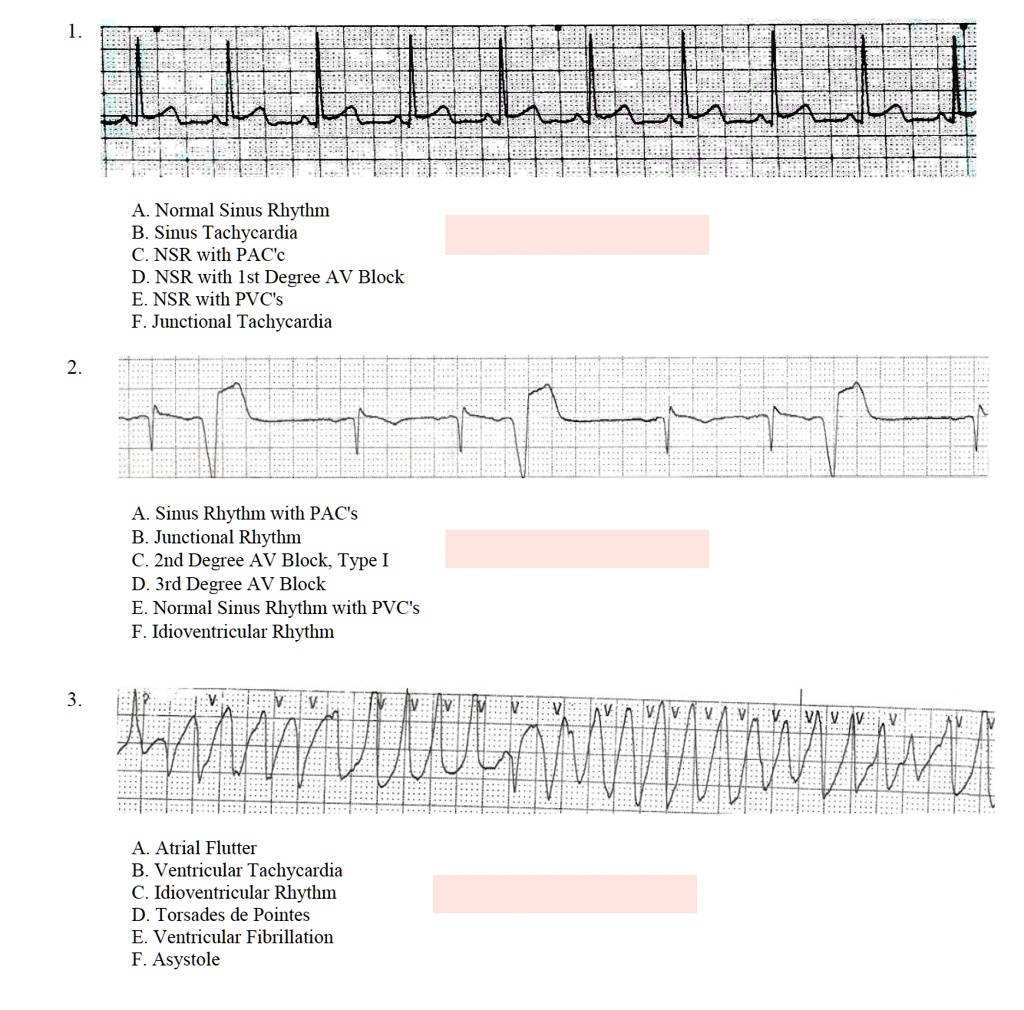 SOLVED: A. Normal Sinus Rhythm B. Sinus Tachycardia C. NSR with PACs D ...