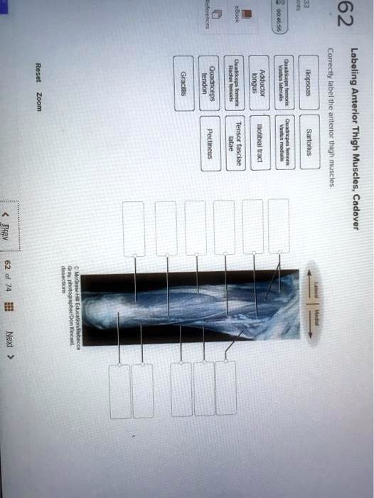 SOLVED Gracilis tendon, Quadriceps longus, Adductor magnus, Pectineus