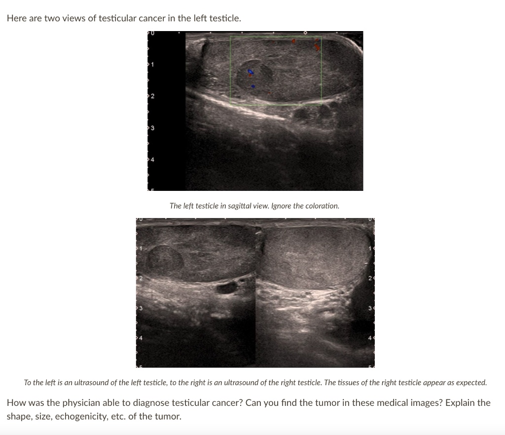 SOLVED Here are two views of testicular cancer in the left testicle