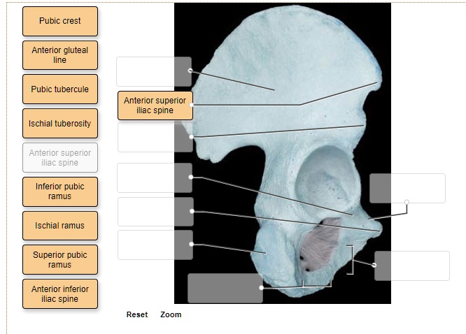 Solved Pubic Crest Anterior Gluteal Line Pubic Tubercle Anterior Superior Iliac Spine Ischial 1099