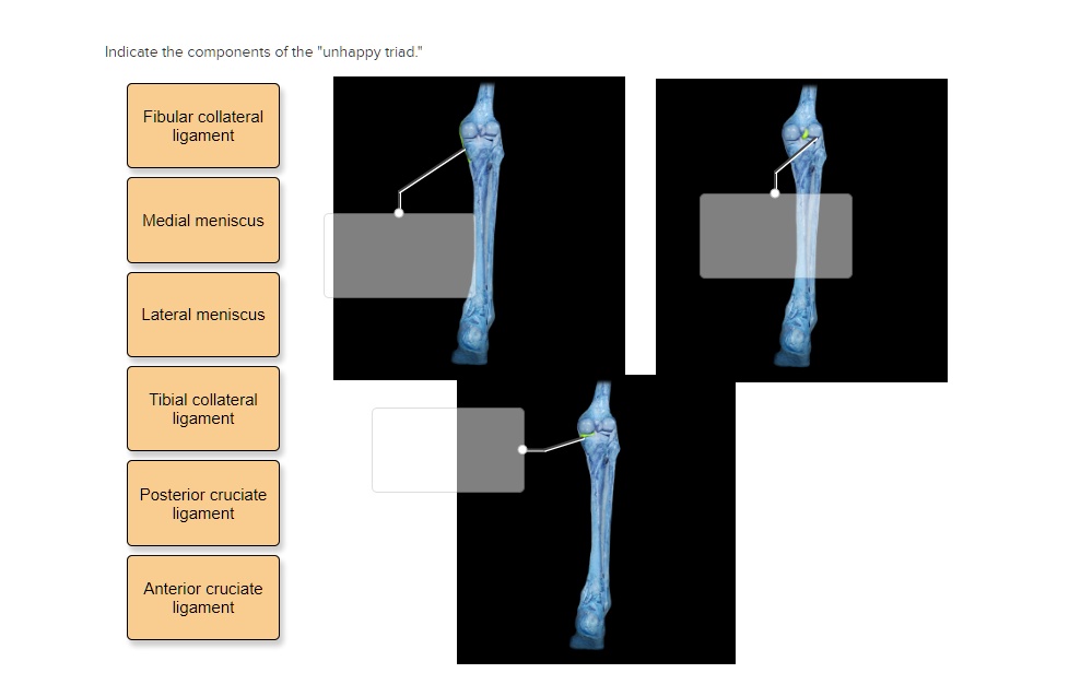 Indicate the components of the "unhappy triad."
Fibular collateral
ligament
Medial meniscus
Lateral meniscus
Tibial collateral
ligament
Posterior cruciate
ligament
Anterior cruciate
ligament