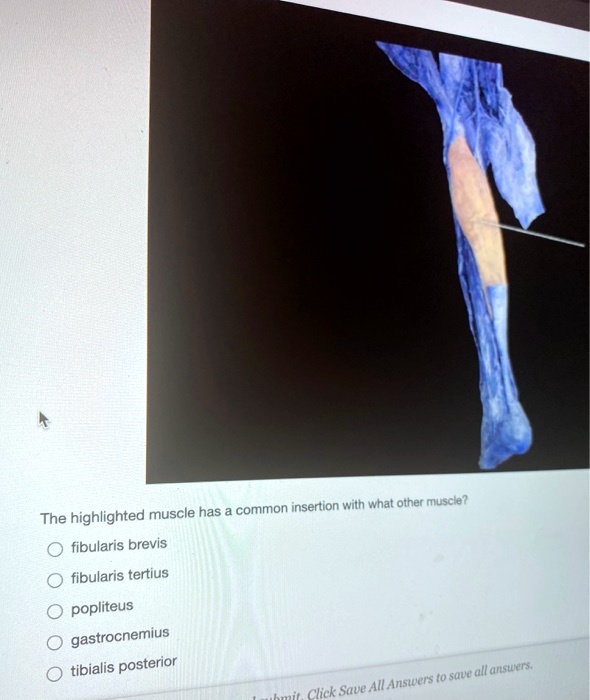 The highlighted muscle has a common insertion with what other muscle? fibularis brevis fibularis tertius popliteus gastrocnemius tibialis posterior