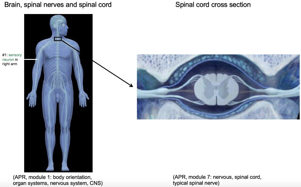 SOLVED Now after the stroke, Mr. Dexter has “diminished pinprick
