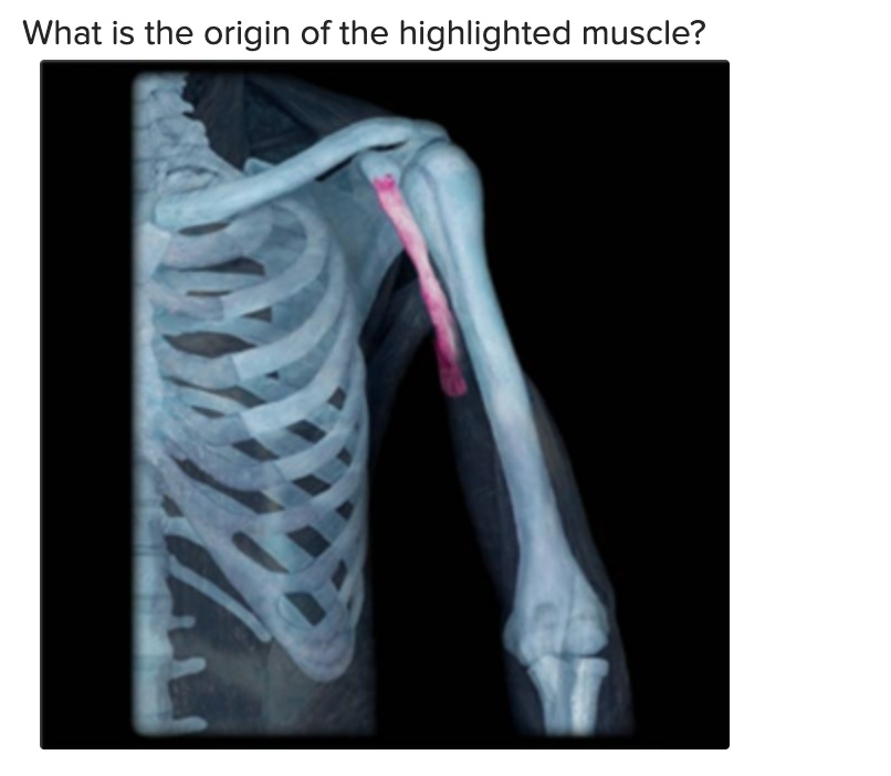 SOLVED a. Inferior clavicular border b. Anterior clavicle c. Acromion