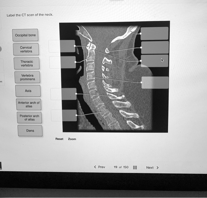 SOLVED: Need help? Label the CT scan of the neck. Occipital bone ...