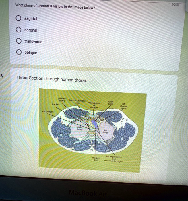 What plane of section is visible in the image below?
sagittal
coronal
transverse
oblique
Three: Section through human thorax
phrenic nerve
brachiocephalic vein
manubrium of sternum
aortic arch
trachea
left phrenic nerve
esophagus
right lung
left lung
T3
thoracic duct
left vagus nerve and recurrent laryngeal