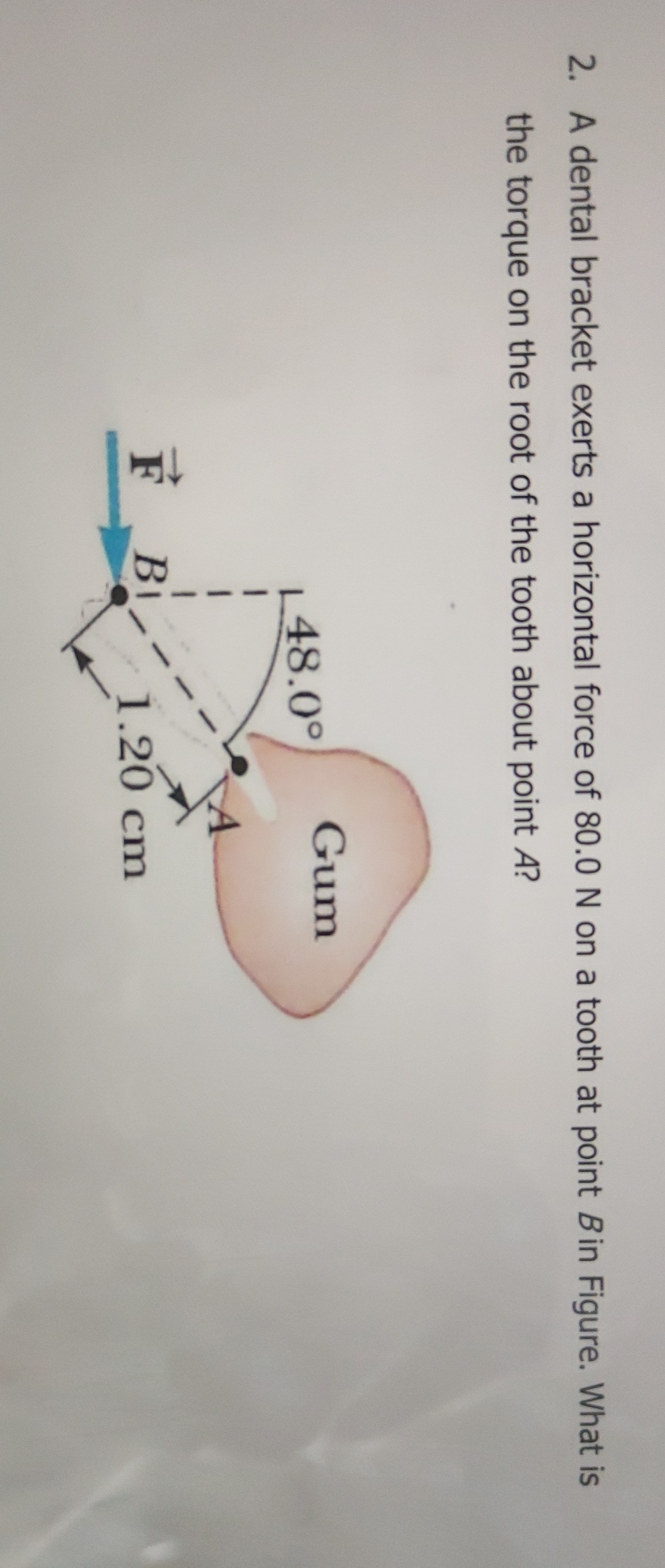 SOLVED 2. A dental bracket exerts a horizontal force of 80.0 N on a