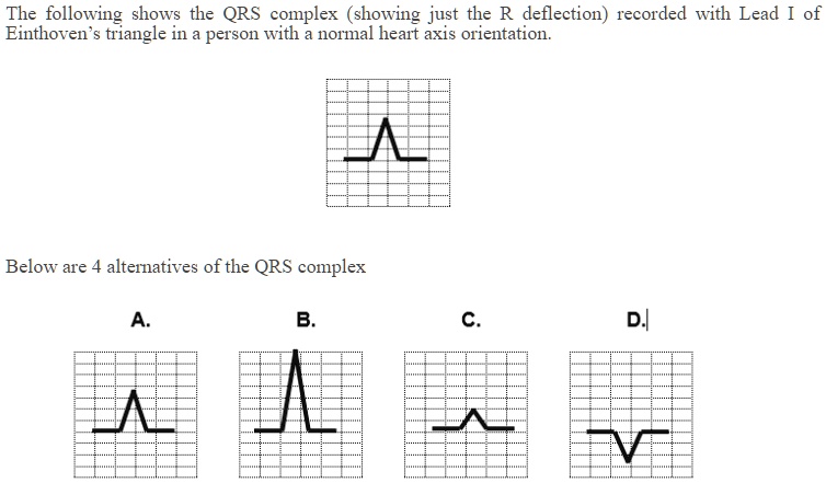 Qrs Complex Deflection SOLVED: The following three situations may cause changes to the QRS ...