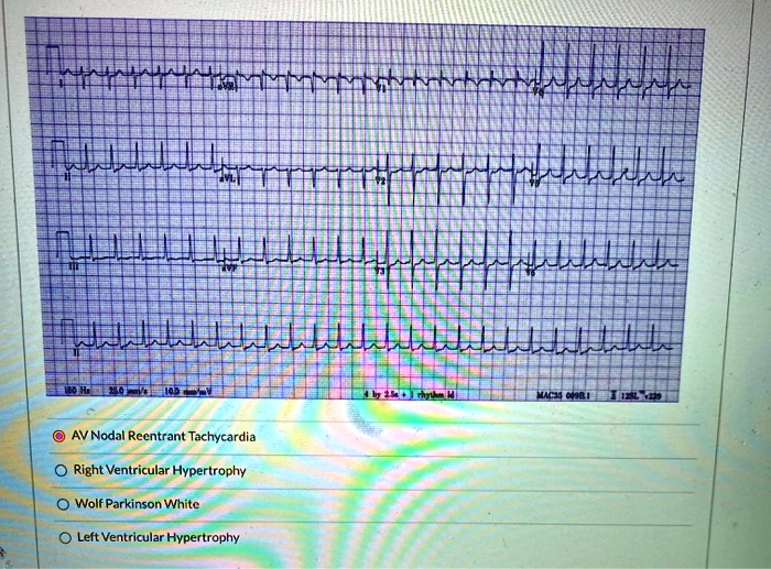 SOLVED: AV Nodal Recntrant Tachycardia Right Ventricular Hypertrophy ...