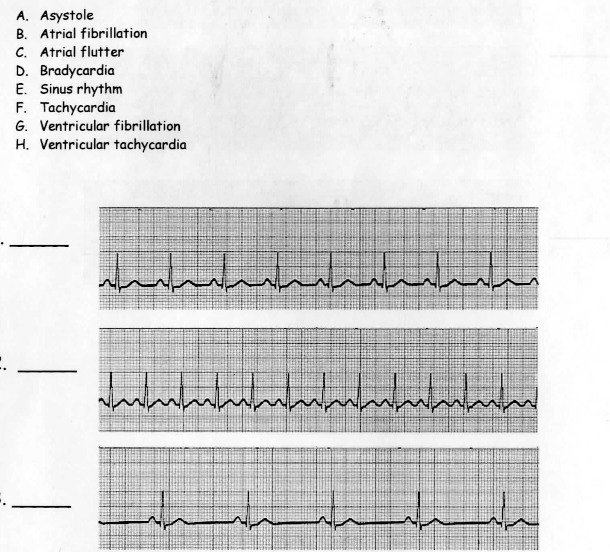 could you please answer and give explanation for the heart condition ...