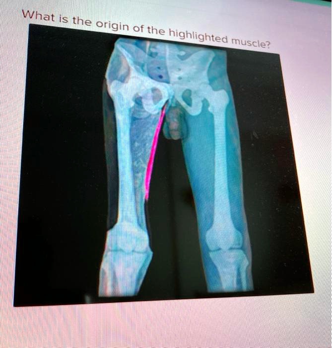 SOLVED: What Ils the origin of the highlighted muscle?