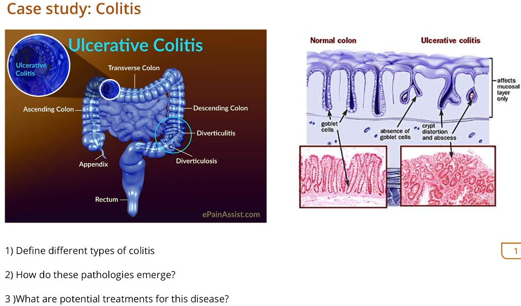 SOLVED Case Study Colitis Ulcerative Colitis Normal Colon Ulcerative