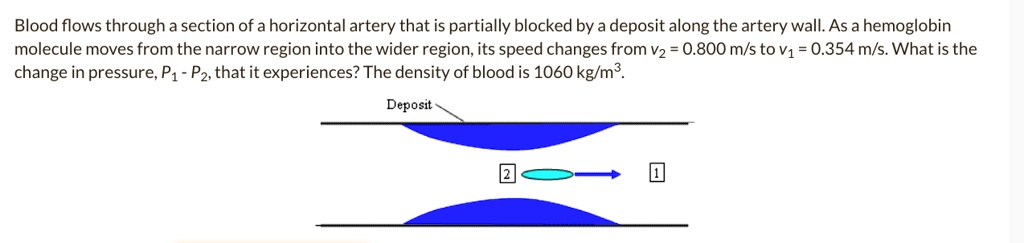 Blood flows through a section of a horizontal artery that is partially blocked by a deposit along the artery wall. As a hemoglobin molecule moves from the narrow region into the wider region, its speed changes from v2 = 0.800 m/s to v1 = 0.354 m/s. What is the change in pressure, P1 - P2, that it experiences? The density of blood is 1060 kg/m³. Deposit 2 1