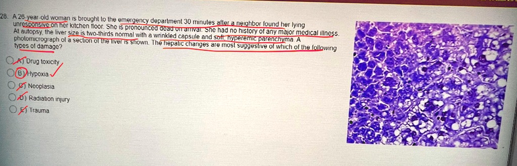 28. A 26-year-old woman is brought to the emergency department 30 ...