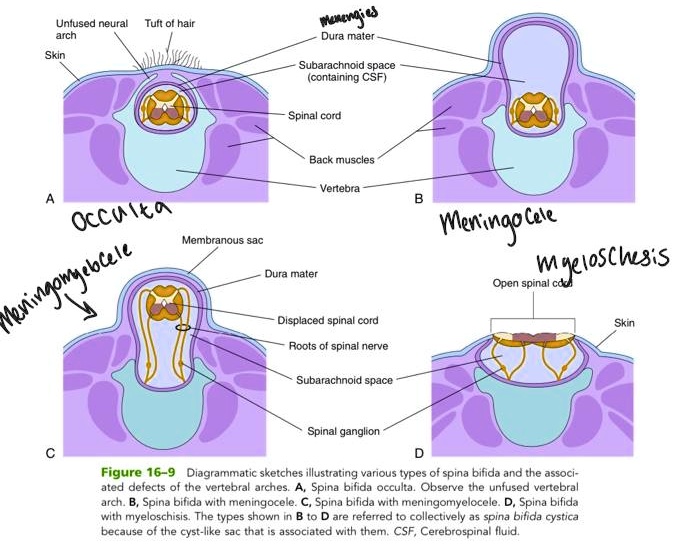 SOLVED Texts 1. There are several types of spina bifida. What causes