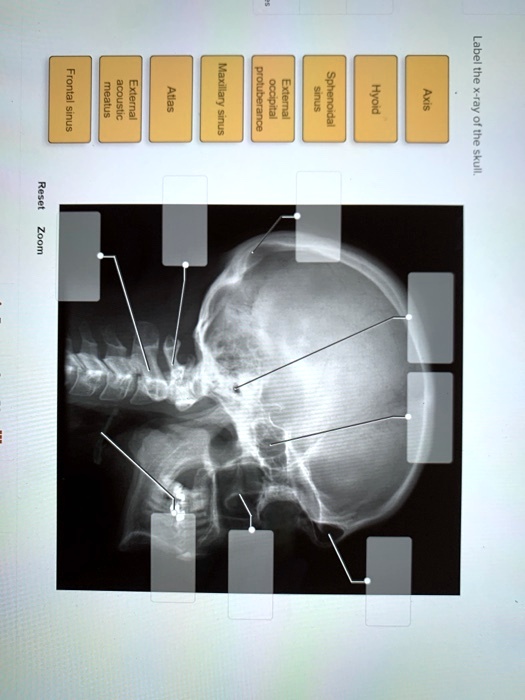 SOLVED Frontal sinus, meatus, acoustic, external, atlas, maxillary
