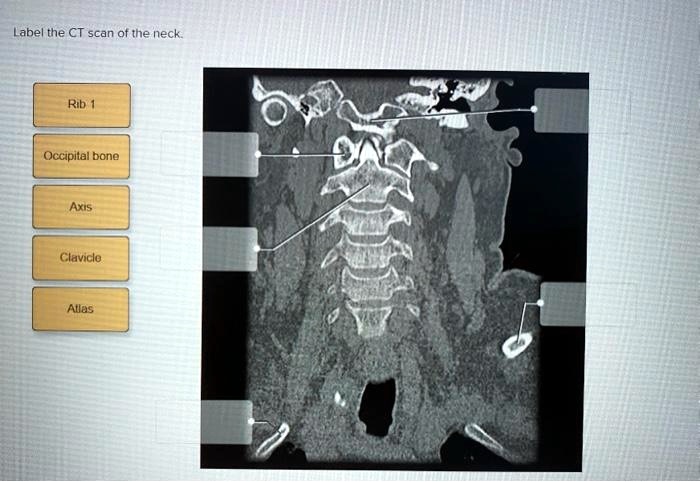 Label the CT scan of the neck.
Rib 1
Occipital bone
Axis
Clavicle
Atlas