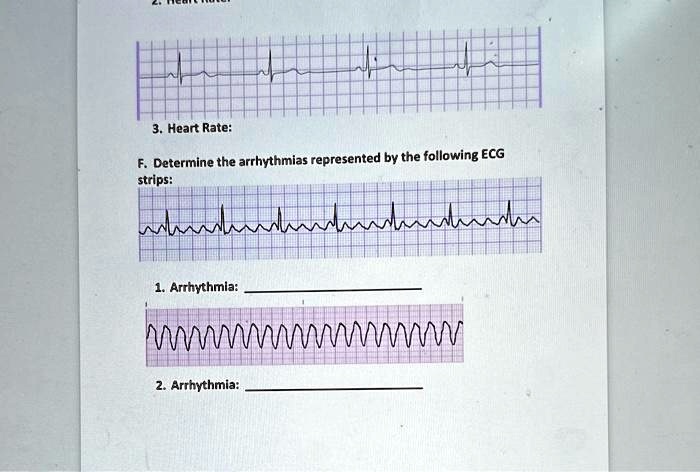 3. Heart Rate:
F. Determine the arrhythmias represented by the following ECG
strips:
1. Arrhythmia:
2. Arrhythmia: