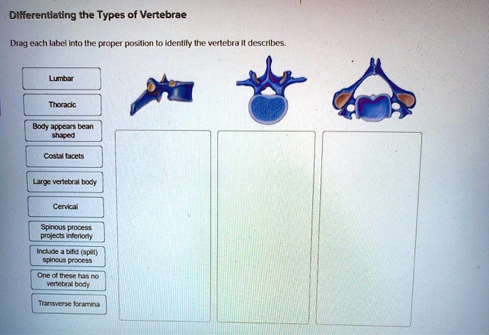 Differentiating the Types of Vertebrae
Drag each label into the proper position to identify the vertebra it describes.
Lumbar
Thoracic
Body appears bean
shaped
Costal facets
Large vertebral body
Cervical
Spinous process
projects inferiorly
Include a bifid (split)
spinous process
One of these has no
vertebral body
Transverse foramina
