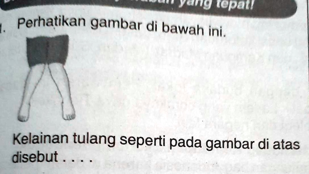 Solved Kelainan Tulang Pada Gambar Diatas Disebut N Ang Topaul