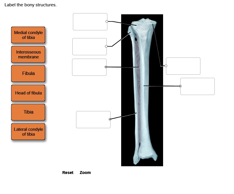 Label the bony structures. Label the bony structures Medial condyle of