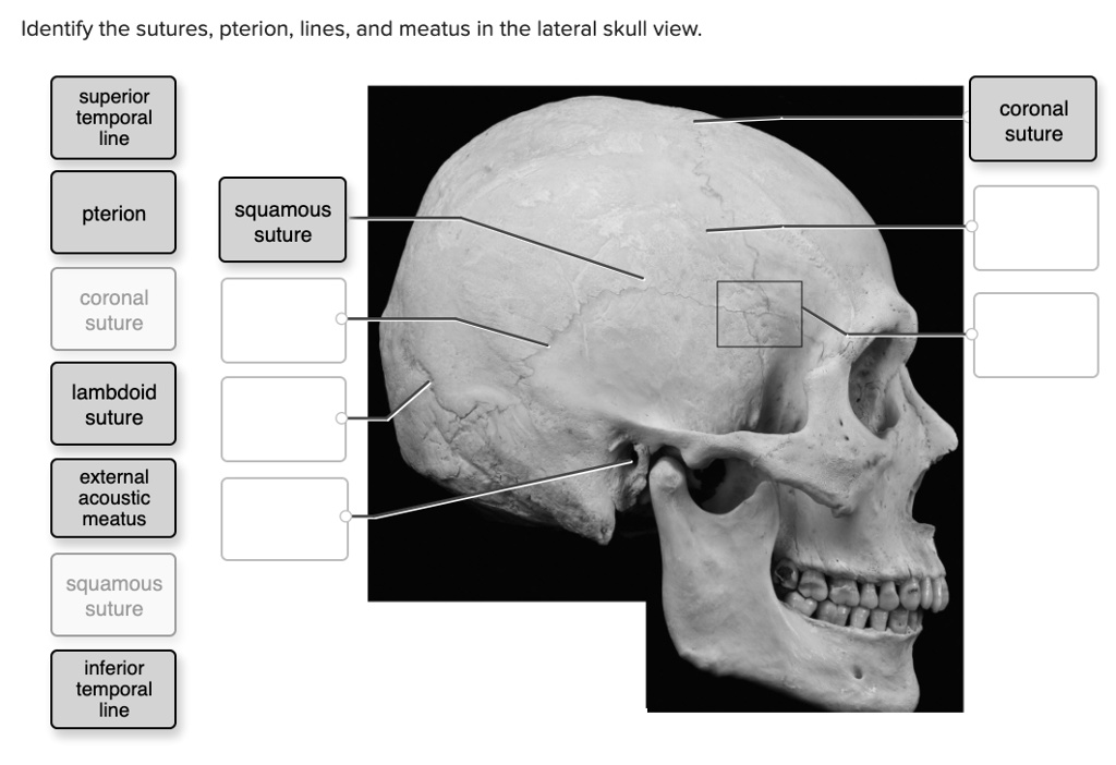 SOLVED: Identify the sutures, pterion, lines, and meatus in the lateral ...