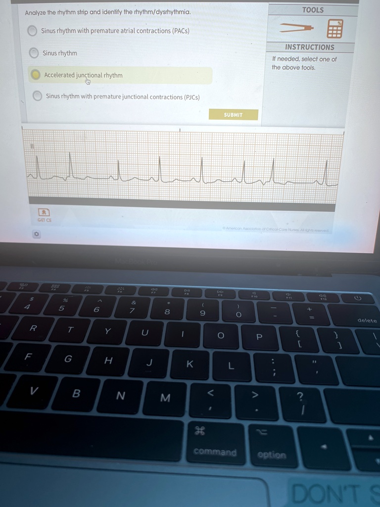 Analyze the rhythm strip and identify the rhythm/dysrhythmia. Sinus ...