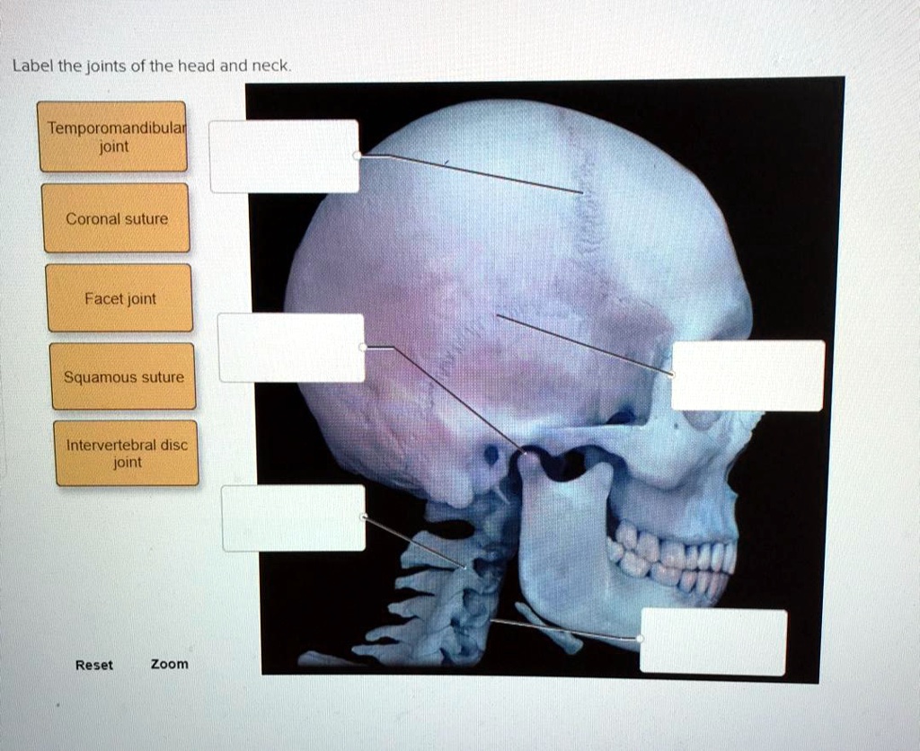 SOLVED Label the joints of the head and neck Temporomandibular joint Coronal suture Facet joint