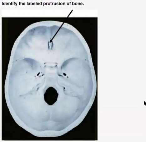 SOLVED: Identify the labeled protrusion of bone