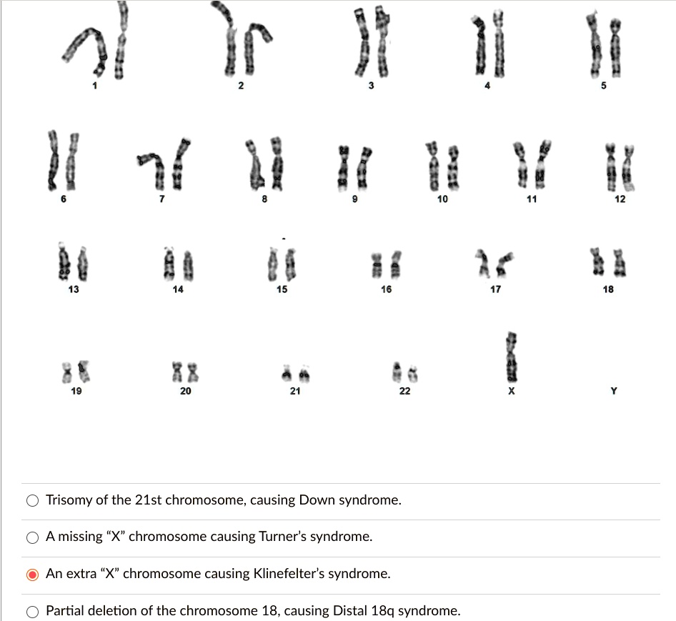 SOLVED V V W 2 V " W 4 Trisomy of the 21st chromosome; causing Down