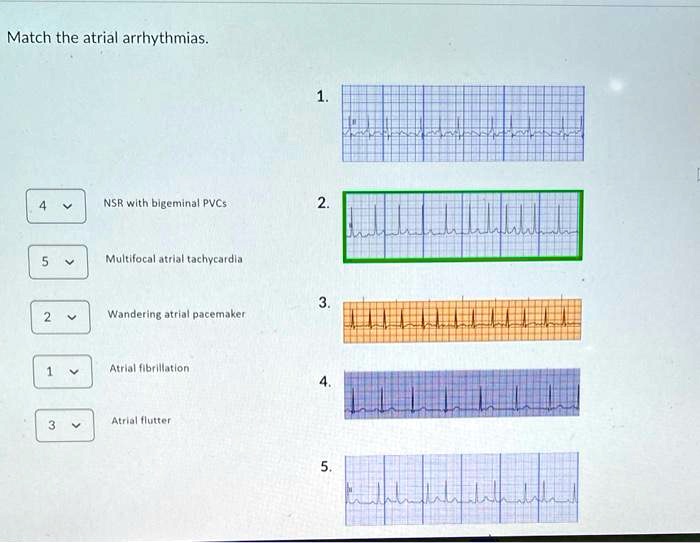 Match the Atrial Arrhythmias NSR with bigeminal PVCs Multifocal atrial ...