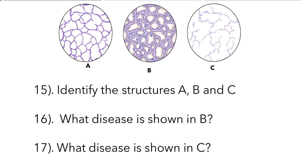 A B C 15). Identify the structures A, B and C 16). What disease is ...