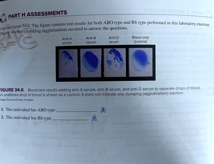 PART H ASSESSMENTS
Examine figure 34.6. The figure contains test results for both ABO type and Rh type performed in this laboratory exercise.
Observe whether clumping (agglutination) occured to answer the questions.
FC
Anti-A
serum
Anti-B
serum
Anti-D
serum
Blood only
(control)
FIGURE 34.6 Blood test results adding anti-A serum, anti-B serum, and anti-D serum to separate drops of blood.
An unaltered drop of blood is shown as a control; it does not indicate any clumping (agglutination) reaction.
image Source/Getty Images
1. This individual has ABO type
2. This individual has Rh type
A
A